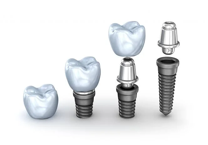 Dental implant sistemi neleri kapsar?